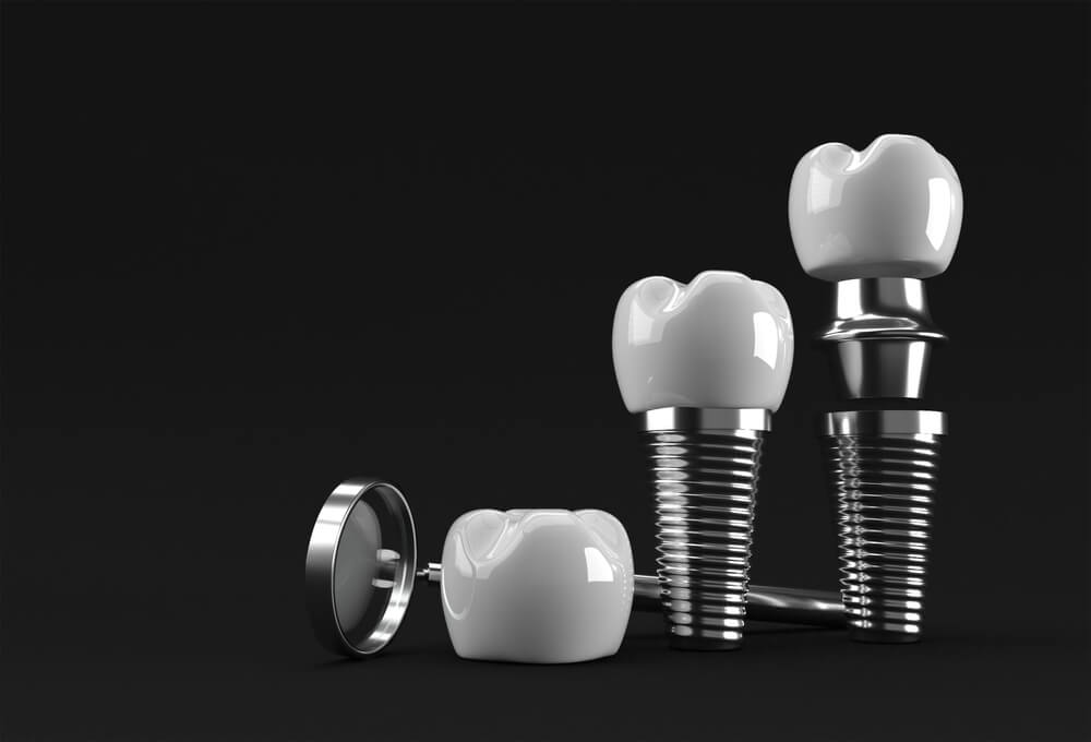 Understanding Dental Implants as a Permanent Solution for Missing Teeth