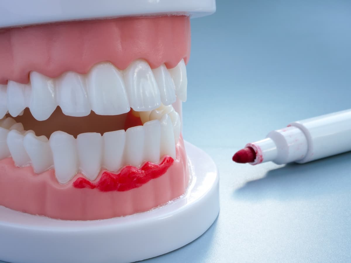 How to Spot Early Signs of Gum Disease in Your Family